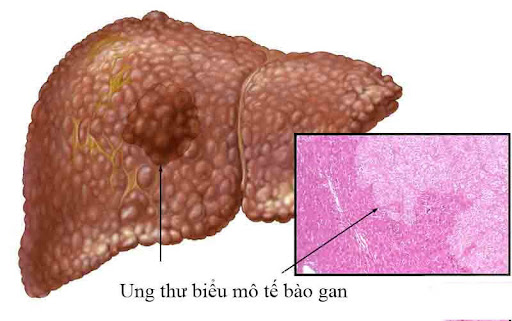 Hình ảnh ung thư biểu mô tế bào gan