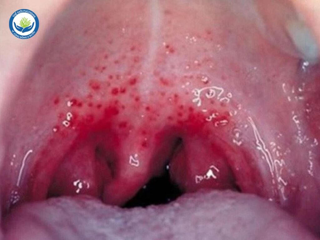 Ung thư vòm họng (K vòm họng)
