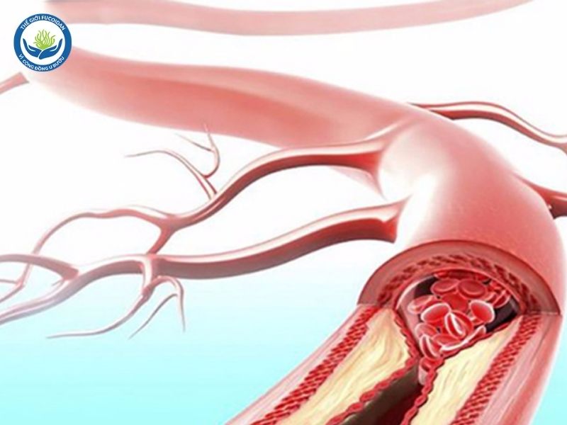 Công dụng của nấm Agaricus là ức chế quá trình hình thành các mạch máu mới 