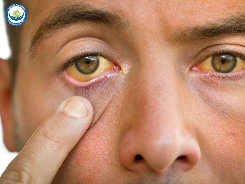Một trong những biểu hiện của ung thư gan HCC là vàng mắt và vàng da