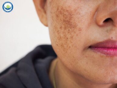 Sạm, nám là triệu chứng rất điển hình của tăng sắc tố da.