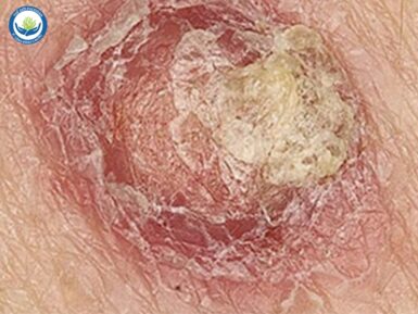 Hình ảnh ung thư biểu mô tế bào vảy.