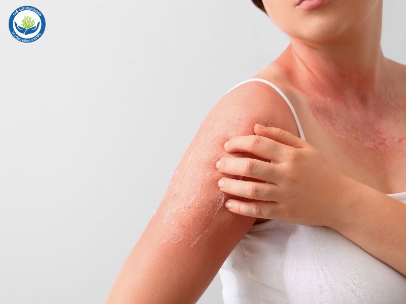 Tiếp xúc với tia cực tím làm tăng nguy cơ mắc ung thư da.