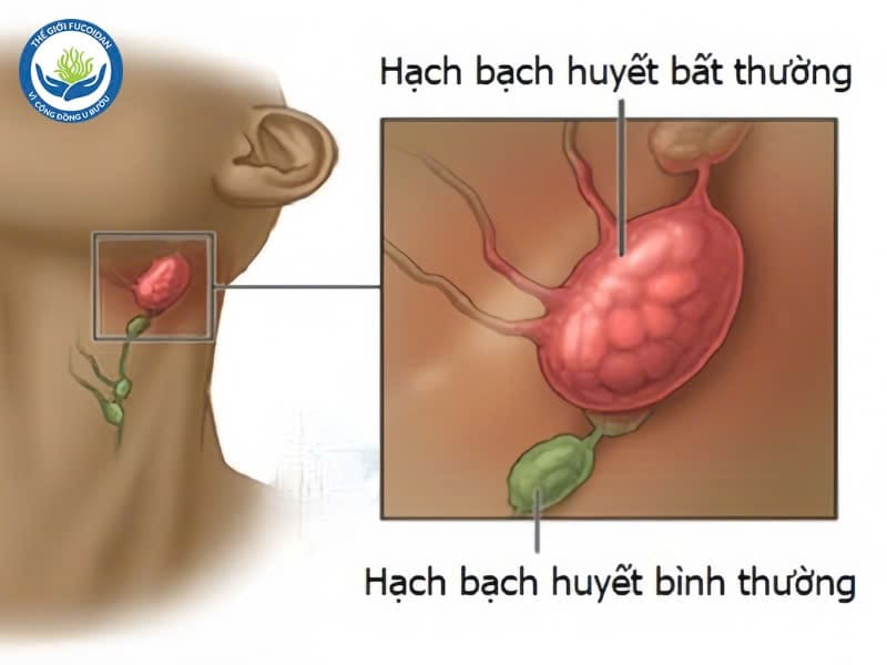 Hình ảnh ung thư tuyến giáp di căn 