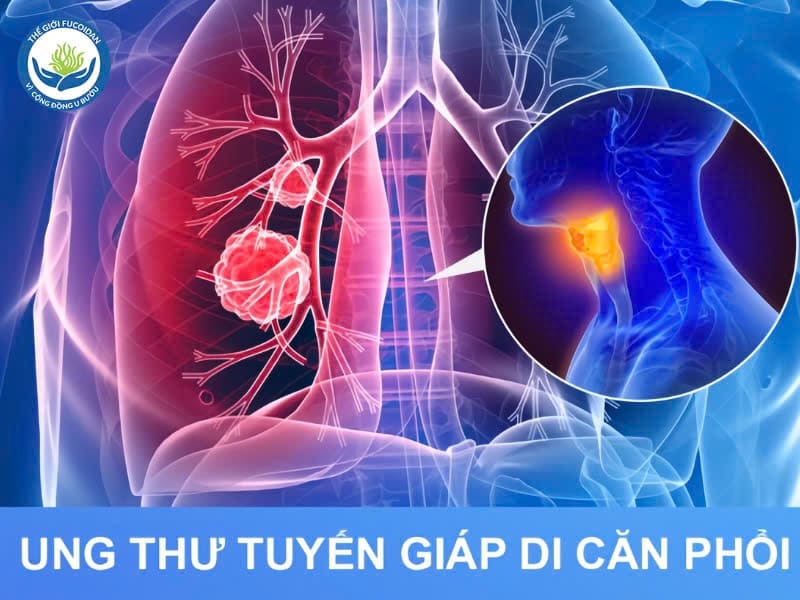 Ung thư tuyến giáp di căn phổi