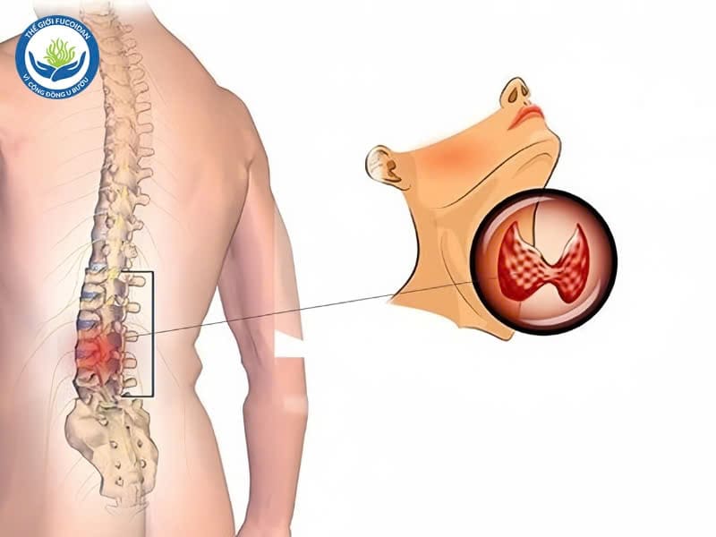 Ung thư tuyến giáp di căn xương