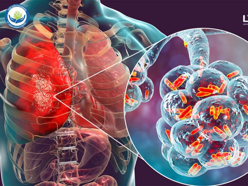 Ung thư phổi là căn bệnh nguy hiểm